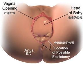 顺产侧切有什么影响？如何恢复已经全部总结验收？