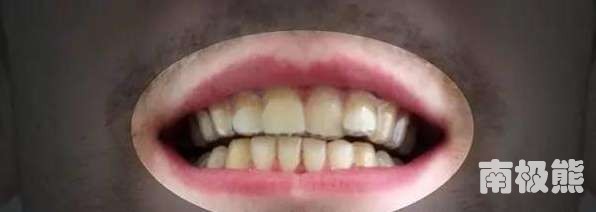 直接3d打印隐形矫正牙套,3d打印隐形牙套制作过程