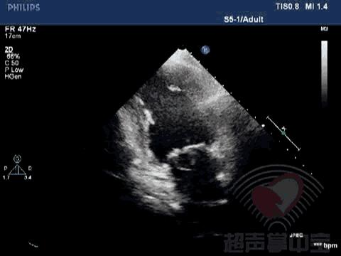 二尖瓣充血性囊肿,二尖瓣血性囊肿是什么意思