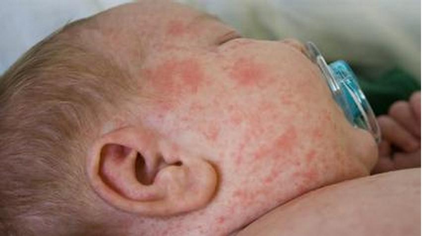 宝宝长痱子怎么办呀,出汗长痱子怎么解决