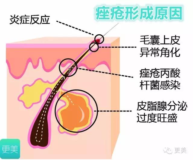 果酸换肤是整容吗,果酸换肤不做后会复发吗