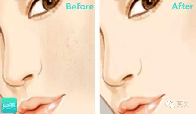 果酸换肤是整容吗,果酸换肤不做后会复发吗