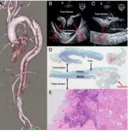 主动脉夹层动脉瘤如何检查和防治,主动脉夹层动脉瘤的超声表现