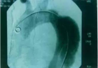 主动脉夹层动脉瘤如何检查和防治,主动脉夹层动脉瘤的超声表现