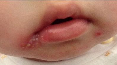 嘴唇上火长泡,变成黑印怎么办?学会自己去火,去黑印