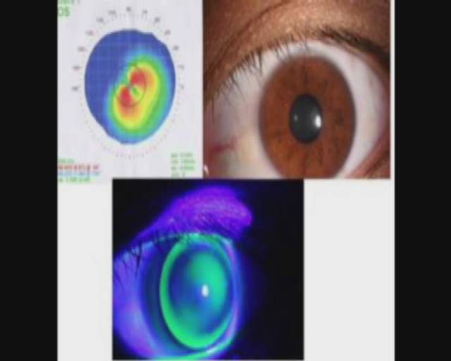 治疗近视的各种手段,记者采访近视眼