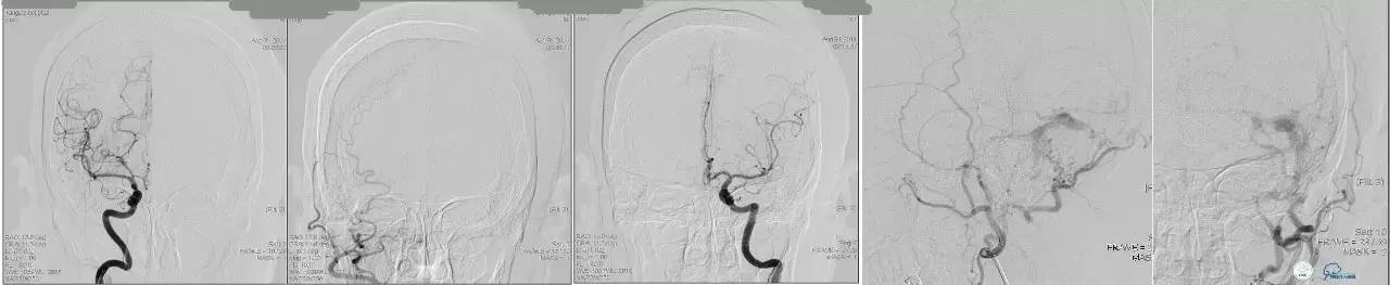 球囊辅助Onyx栓塞治疗硬脑膜动静脉瘘（DAVF）