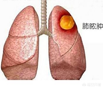 肺上有个洞吐出来的痰又臭又黑,轻微肺堵塞能咳出痰很浓的痰