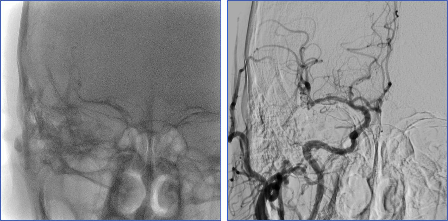 缺血性脑卒中术后管理,急性缺血性脑卒中血管内治疗