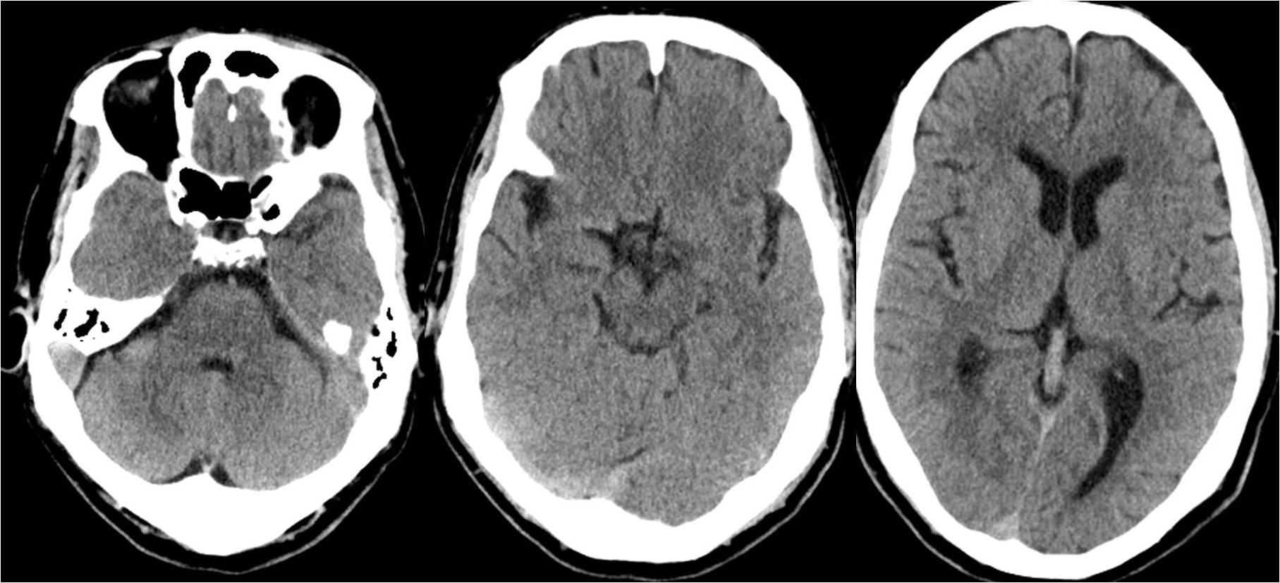 缺血性脑卒中术后管理,急性缺血性脑卒中血管内治疗