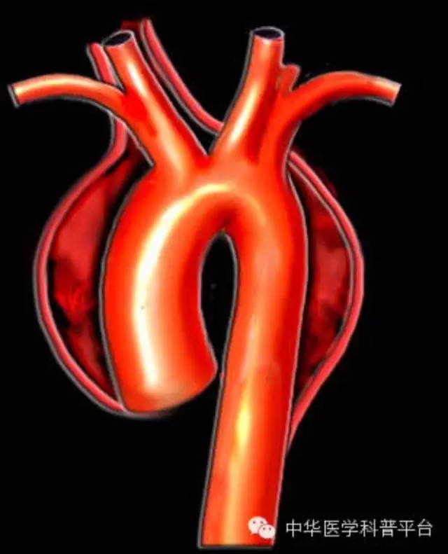 主动脉夹层什么症状,心脏主动脉夹层破裂