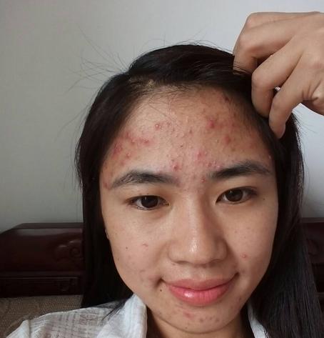 长痘最好的办法就是不要碰它,各种痘对应解决方法