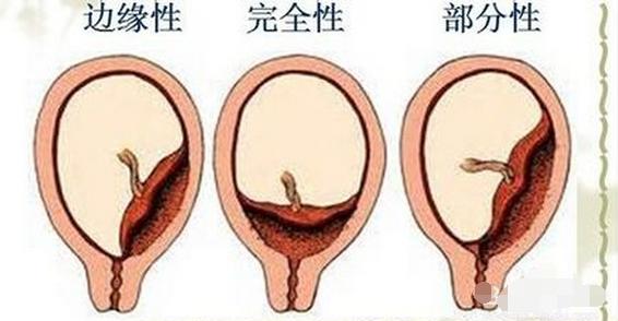 中央型胎盘前置有什么方法可改善,查出完全性前置胎盘怎么办