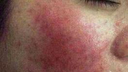 激素性皮炎修复期为什么脸总痒,激素性皮炎反复起红疹怎么办