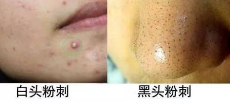 脸上老长闭合性粉刺是什么原因,脸上老是长闭合性粉刺是怎么回事