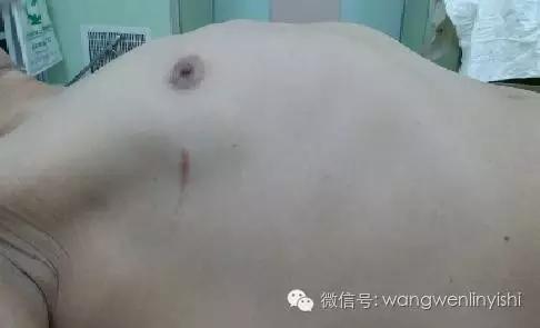 桶状胸微创手术,漏斗胸最先进的手术