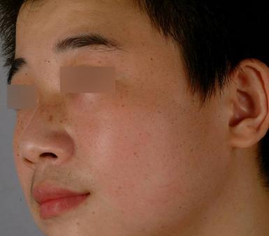 男性怎么治疗由电脑辐射引起的*褐斑黄**