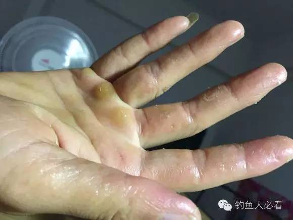 饵料烧手手很痒怎么缓解,对于饵料过敏怎么根治