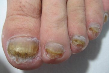灰指甲的致病原因,灰指甲颜色呈黑色
