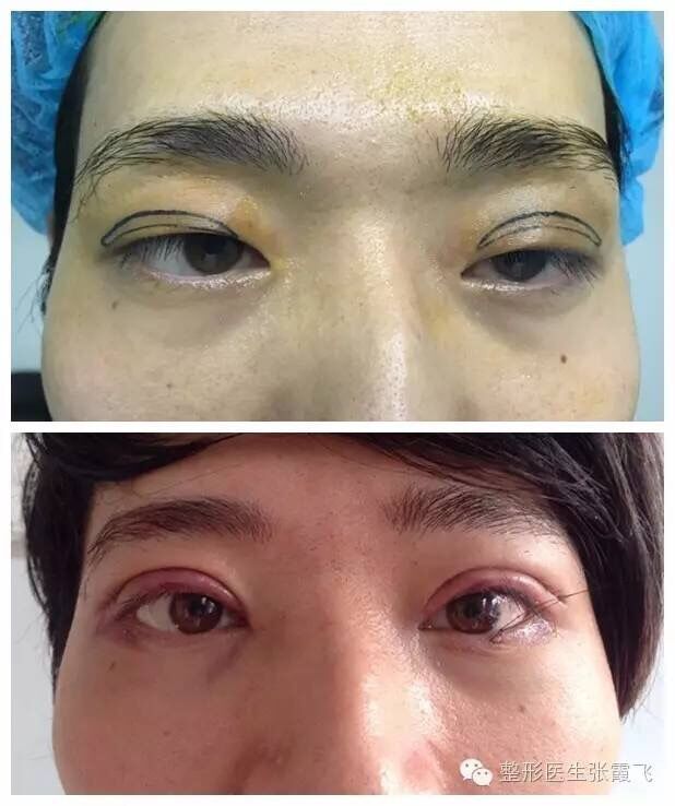 上睑下垂矫正多少钱,上睑下垂该怎么办