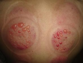 拔罐出现水泡要挑破吗,为什么拔罐会有水珠