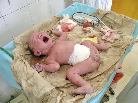 剖腹产的妈妈有多伟大,剖腹产的妈妈最伟大