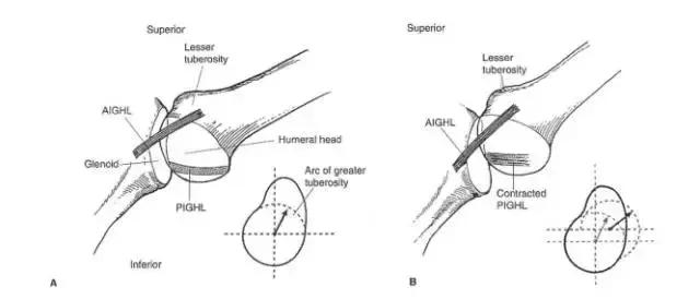 肩部撞击症,肩部撞击怎么康复