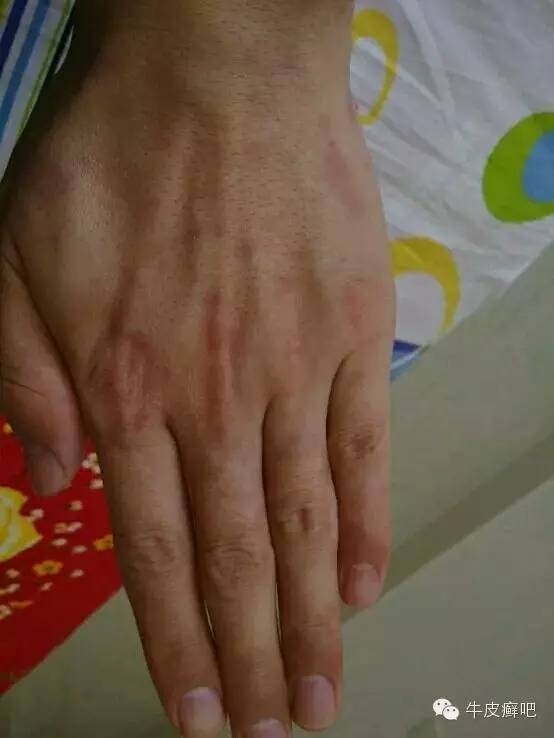 医院专家教你治疗牛皮癣,专家专治牛皮癣方法