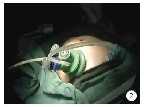 手术演示肠造口术后单切口腹腔镜辅助巨结肠根治术（Duhame1术）