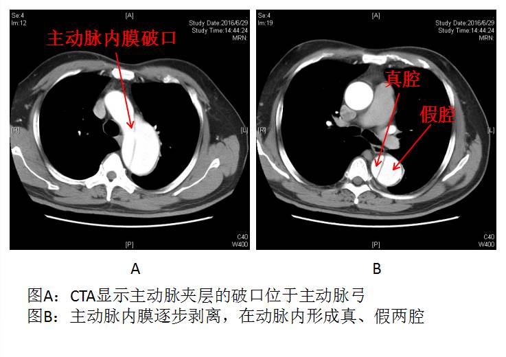 西京医院治疗心脏主动脉夹层,交大一附院治疗主动脉夹层