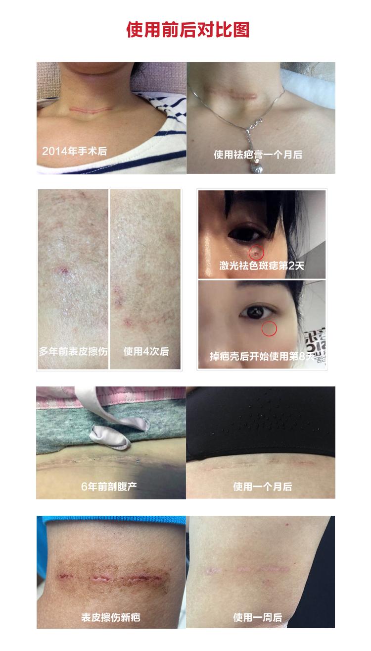 你知道如何挑选祛疤产品吗？三款知名祛疤膏对比