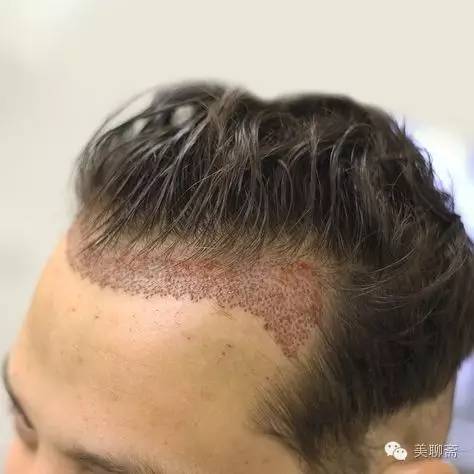 植发亲历,亲身体验植发