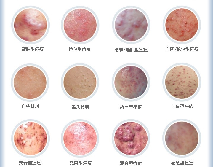 痘痘怎么快速消除医生推荐,痘痘怎么快速消除用什么方法