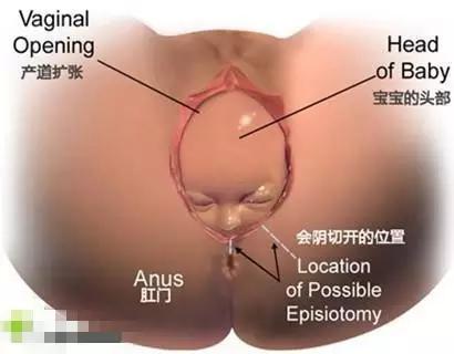 准妈妈对于侧切你了解多少,侧切的宝妈