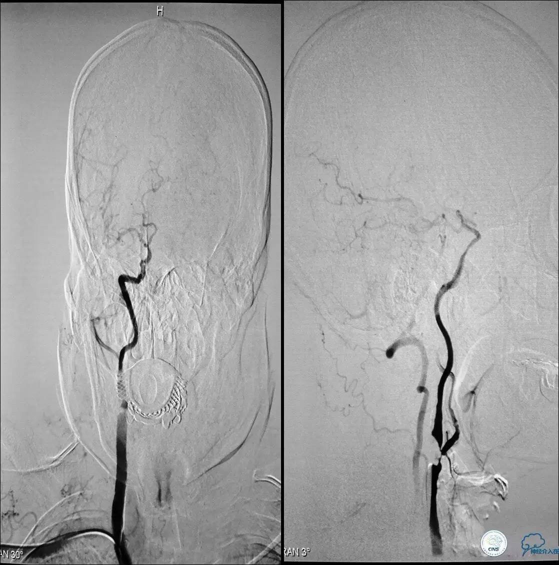 颈动脉次全闭塞,颈动脉次全闭塞中医疗法