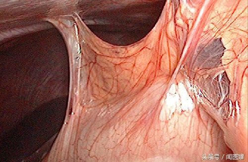 妇科腹腔手术后怎么护理,剖宫产腹腔粘连要手术吗