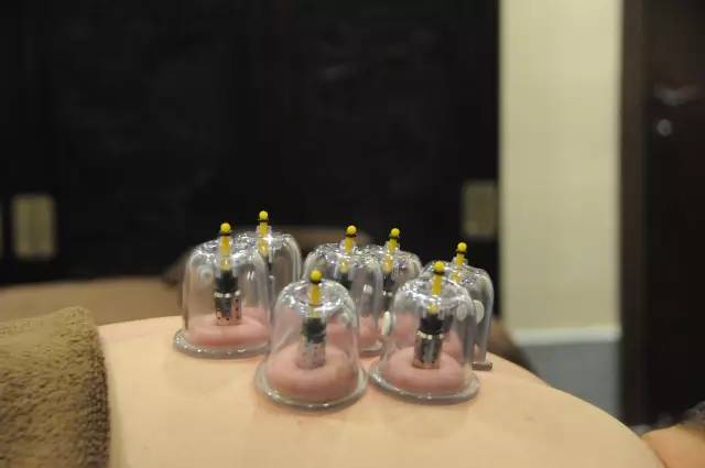 拔火罐有真空原理吗,拔火罐的来源