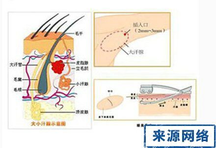 腋窝下有股难闻的味道,腋窝有味道怎么办