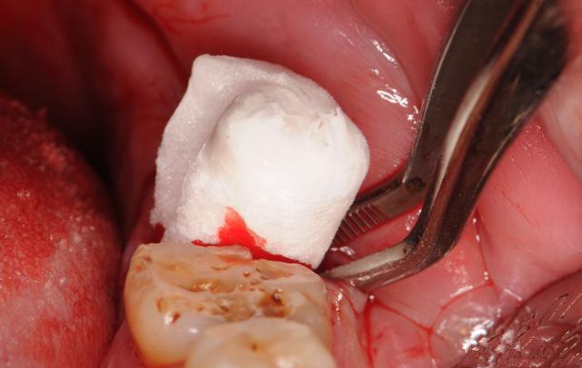 拔牙到底有多惨,拔牙都有什么有趣的经历