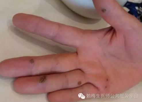 火针灸能治跖疣吗,中医火针治疗丝状疣