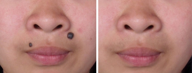 孙红雷谈黑痣长在哪里,孙红雷演的黑痣病变