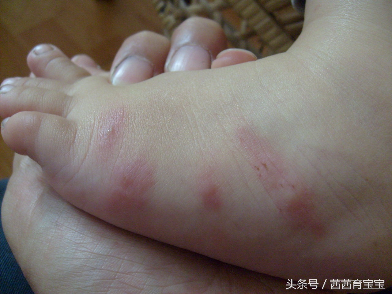 宝宝长湿疹是因为热吗,宝宝屁屁长湿疹怎么办