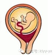 孕期出血有哪些危险,孕期阴道出血的症状