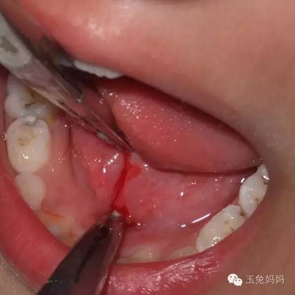 宝宝舌系带短吃不到奶可以剪吗,宝宝吃不到左边奶怎么回事