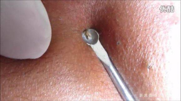 去黑头小技巧外国人,去黑头不需要任何工具的方法