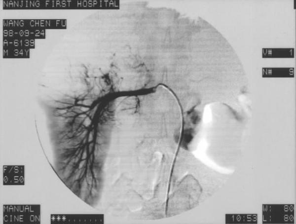 肾恶性肿瘤切除后能活多久,肾恶性肿瘤手术费用