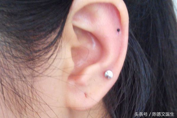 耳洞发炎红肿能摘吗,耳洞附近反复发炎怎么办