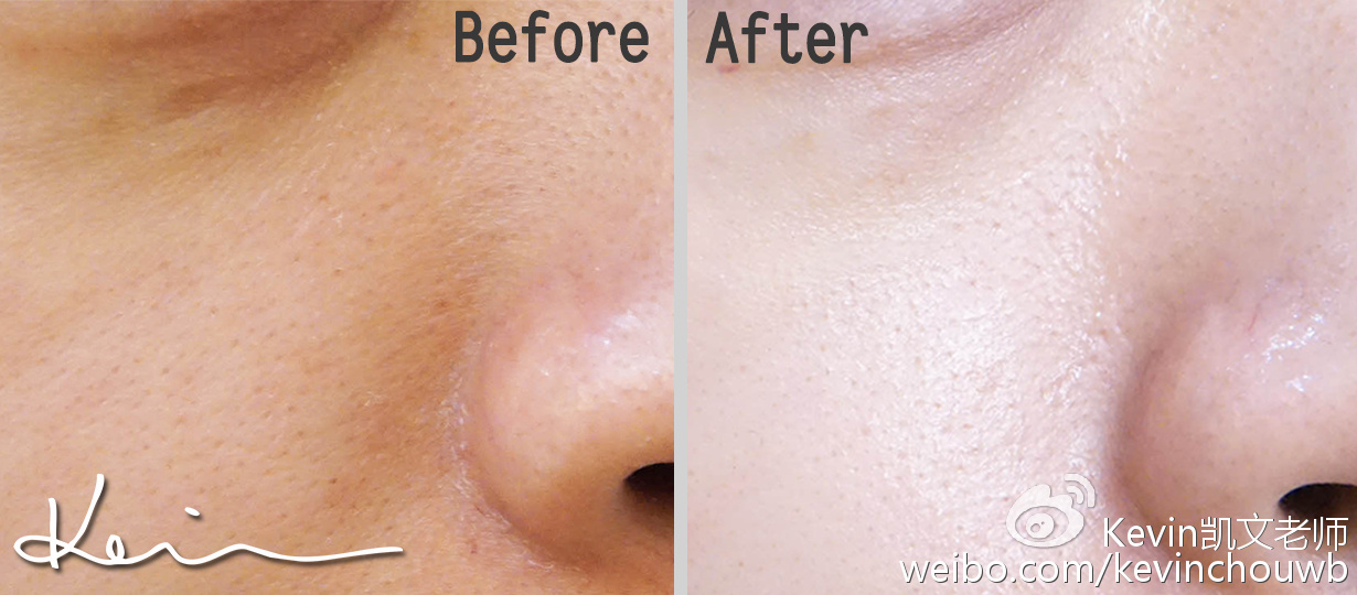 痘痘黑头粉刺用什么化妆品,痘痘粉刺黑头用什么化妆品