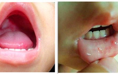 我女儿手脚冰凉怎么治,女儿得手足口病了咋办