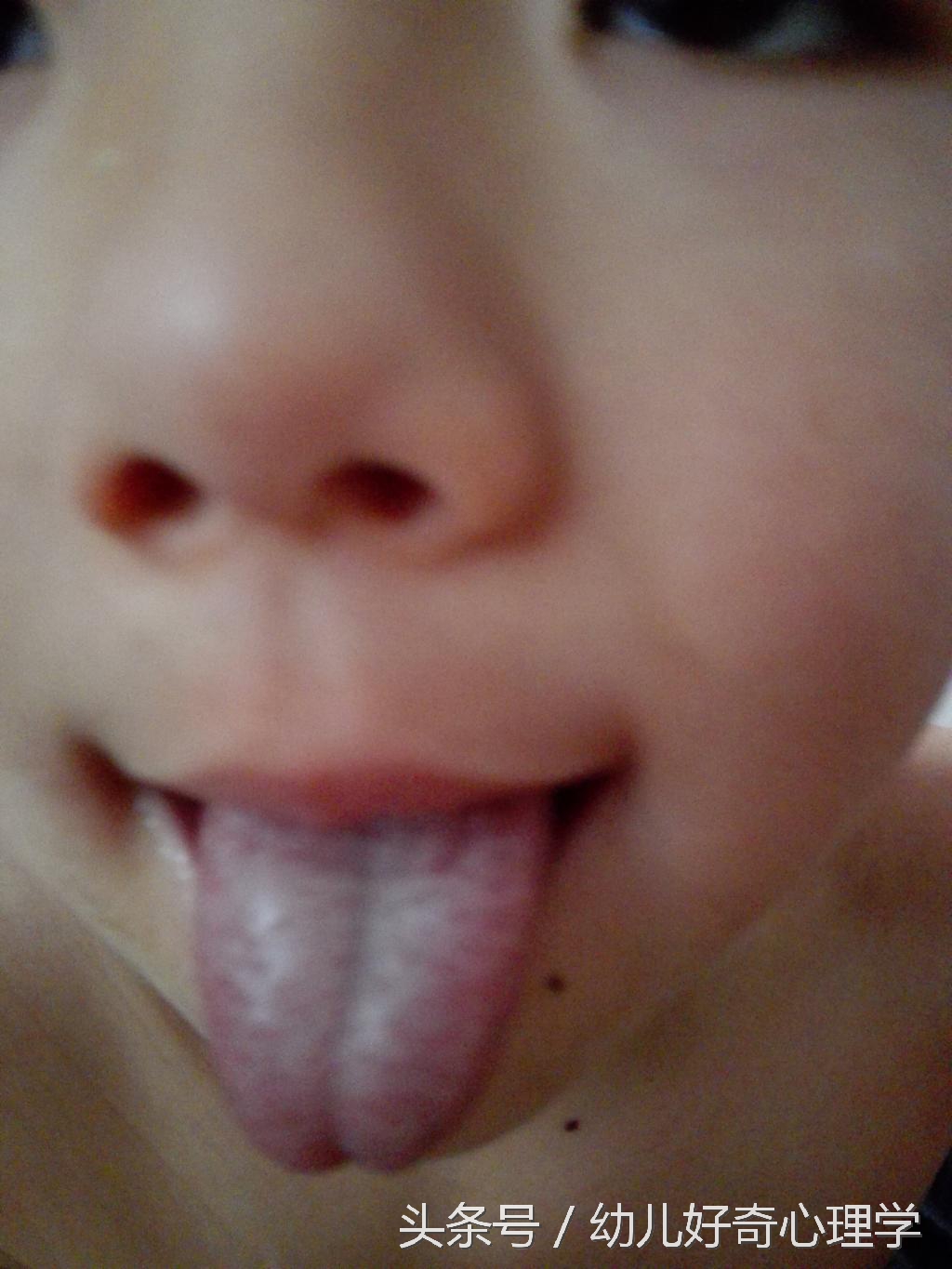 婴儿舌头底下血管发紫是怎么回事,婴幼儿舌头发黑是怎么回事